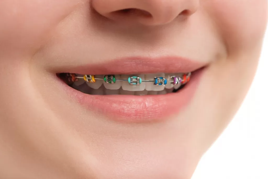 colored orthodontics