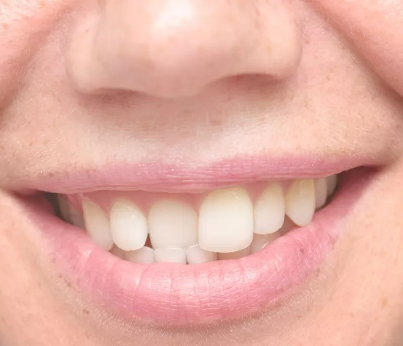 correction of teeth instant orthodontic