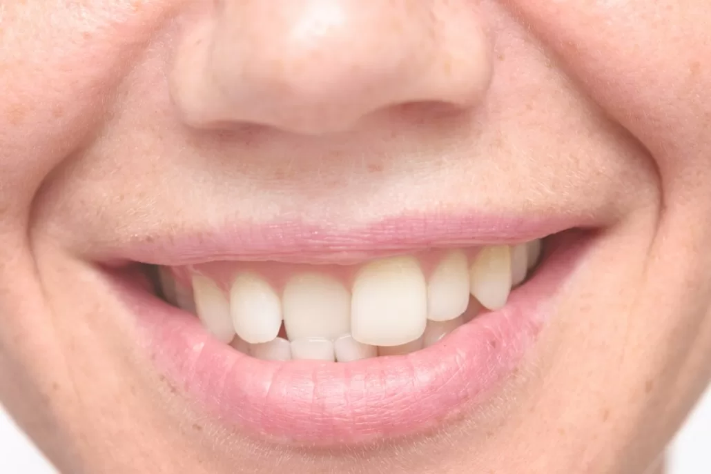 Correction Of Teeth Instant Orthodontic
