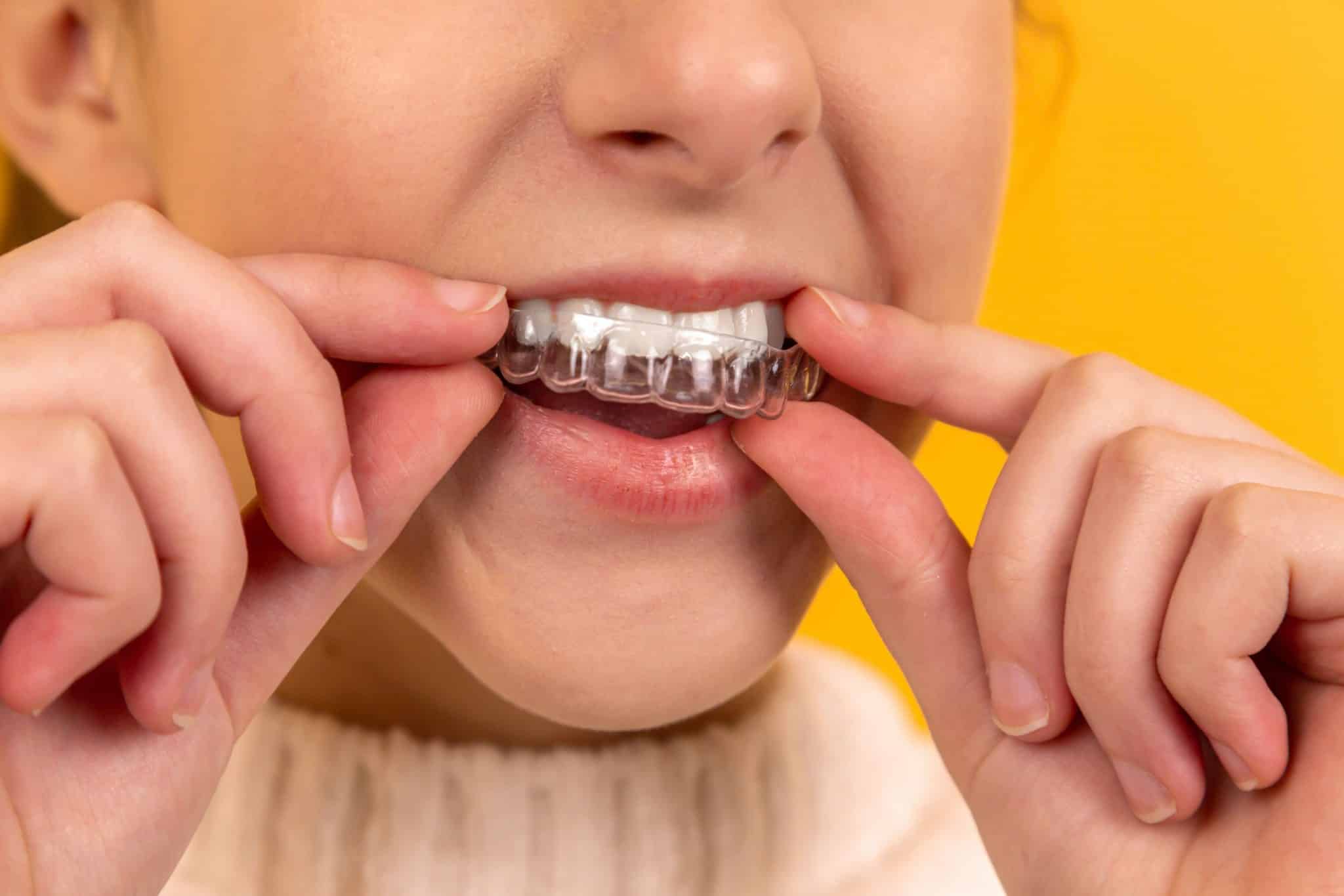Patient using clear aligners