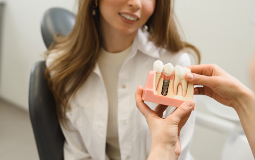 toluca lake dental implants blog