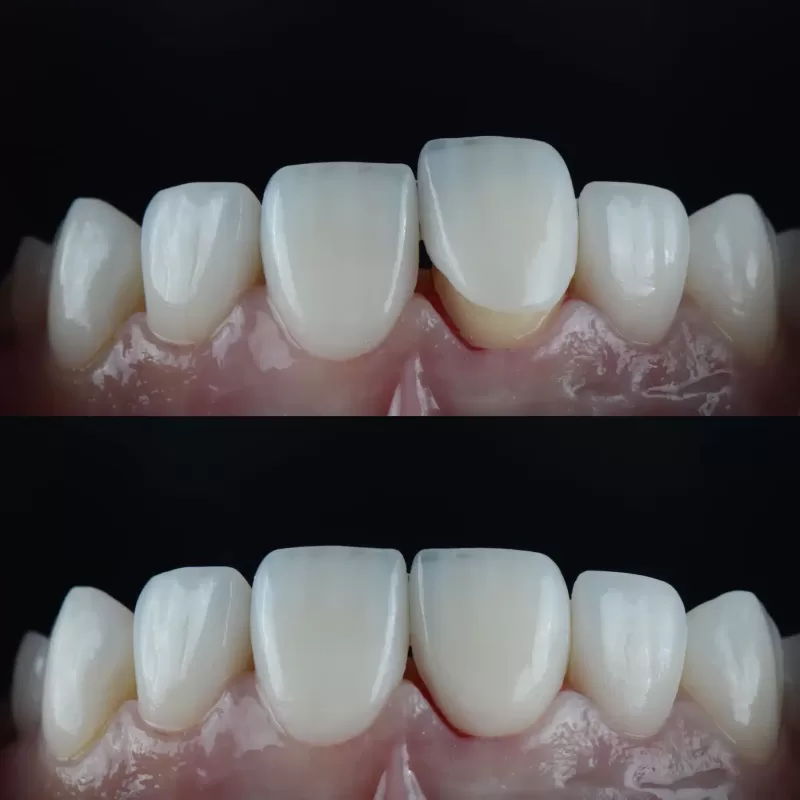 Dental crown being placed on natural etched tooth