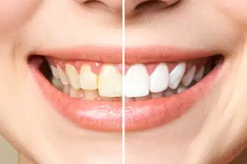 teeth whitening special toluca lake