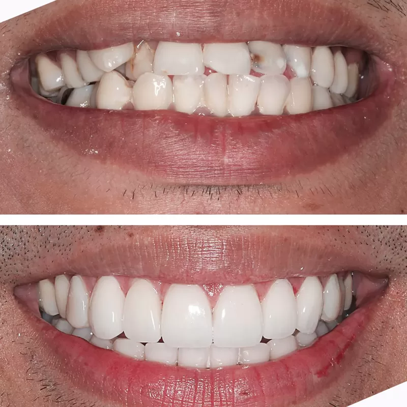 Before,&,After,Treatment,With,New,Smile,By,Dentist