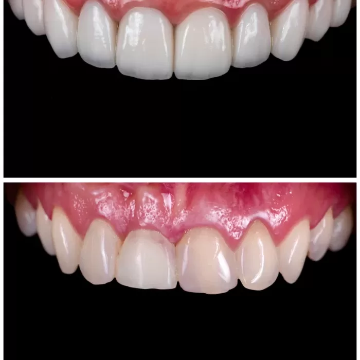 Full,Smile,Reconstraction,By,Precc,Ceramic,Crowns,And,Veneers