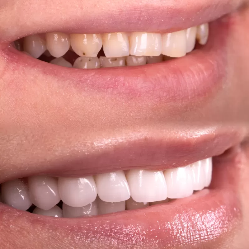 Perfect,Smile,Before,And,After,Bleaching,Procedure,Whitening,Of,Zircon