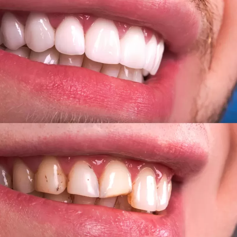 Before/after of chipped tooth being fixed with veneers procedure