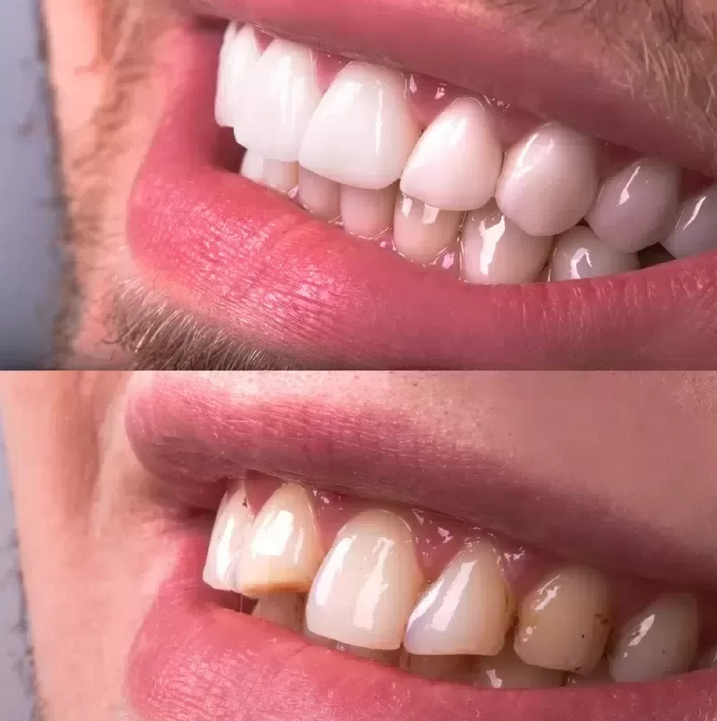 Before/after of chipped tooth being fixed with veneers procedure