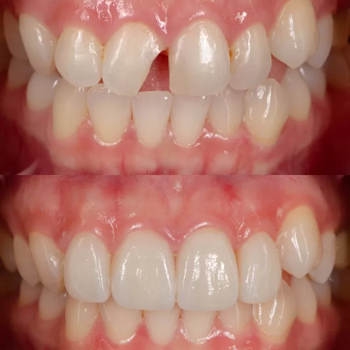 Before,And,After,Treatment,With,Dental,Veneers,On,Four,Front