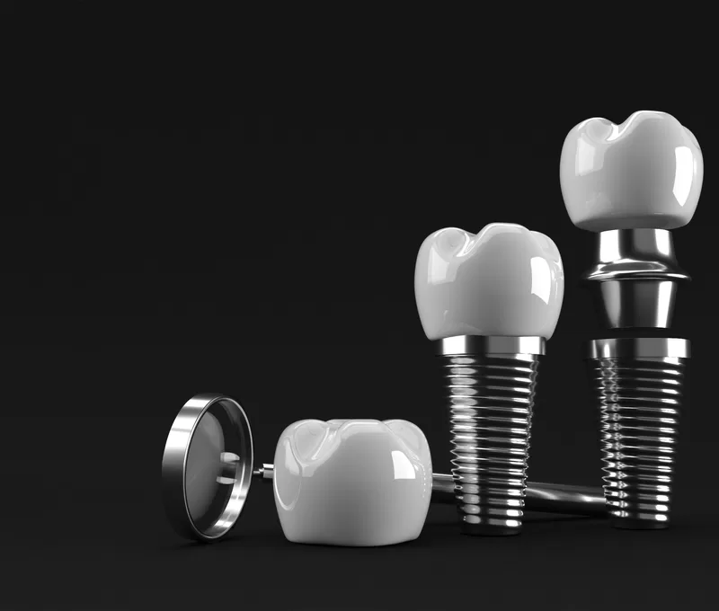 Restorative dentistry service - Dental implants and crowns