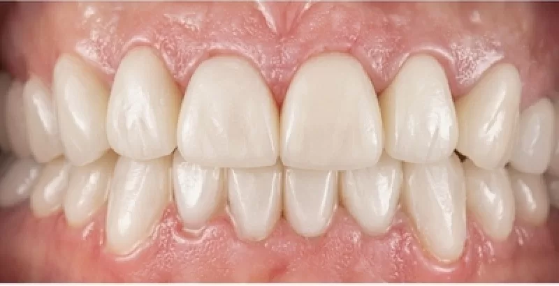 After veneers and bonding North Hollywood