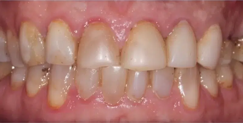 Before veneers and bonding North Hollywood