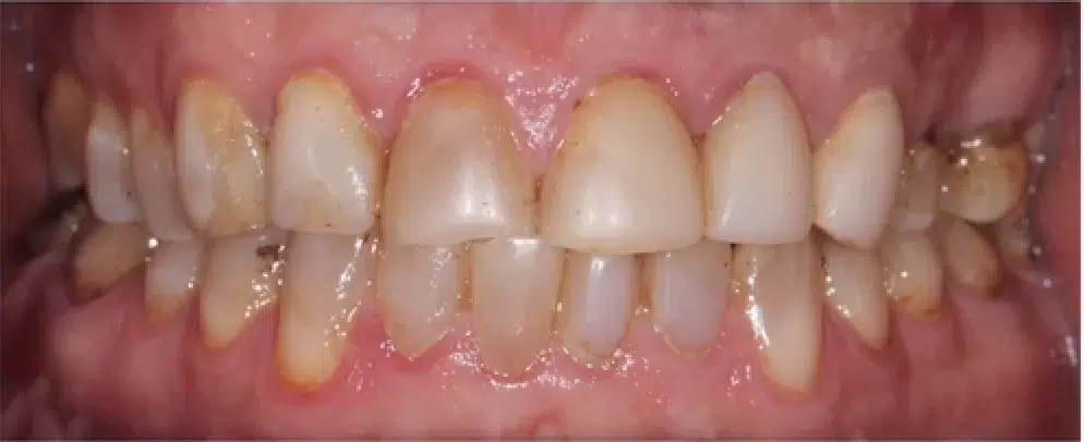 Before Pic of yellow stained teeth