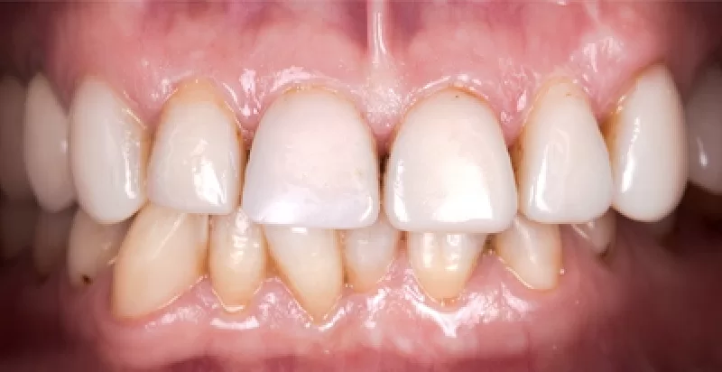 Before veneers aligners and whitening North Hollywood