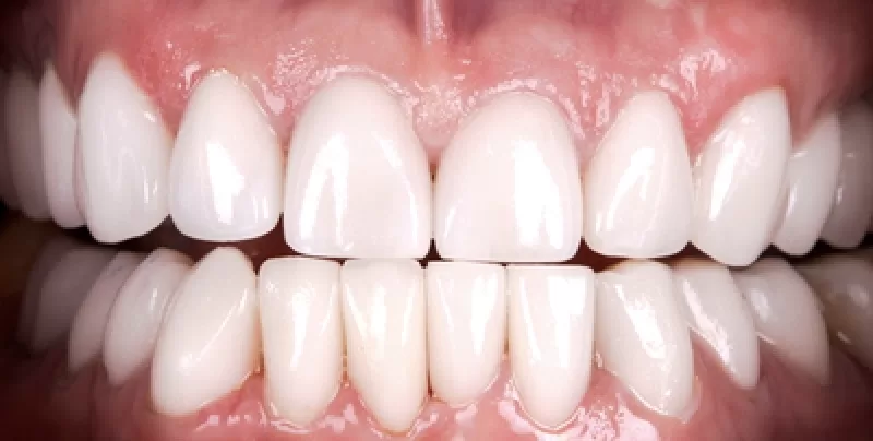 After veneers aligners and whitening North Hollywood