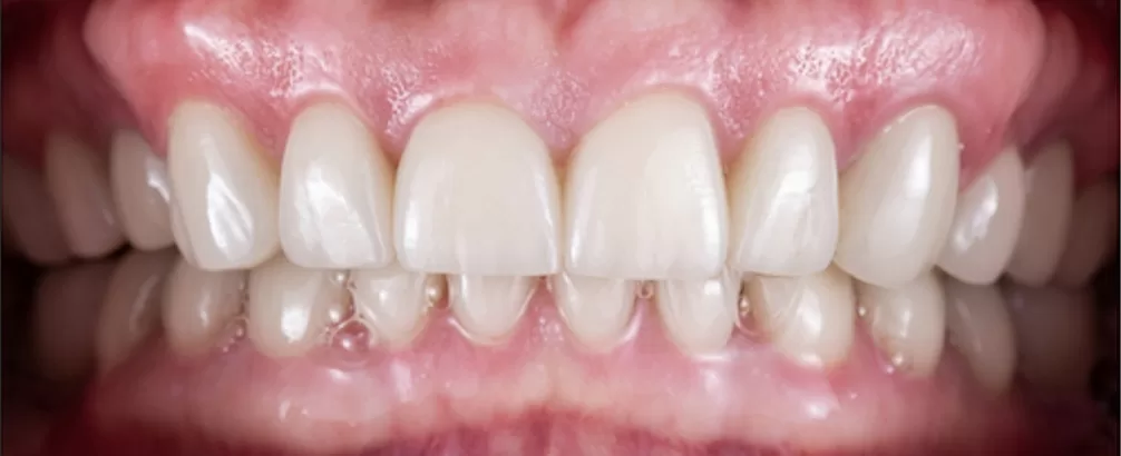 After Pic: Whitened Teeth with Implants placed