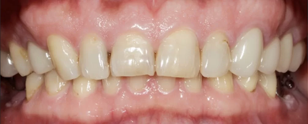 Before Pic: Stained and prepped teeth for implant placement