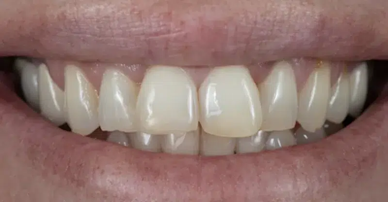 Before teeth reshaping bonding and veneers