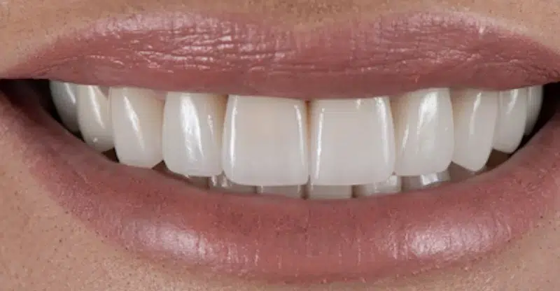 After teeth reshaping bonding and veneers