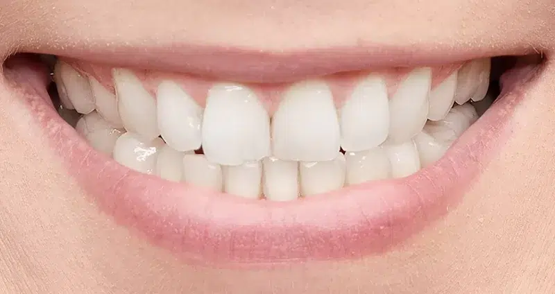 After professional teeth whitening North Hollywood