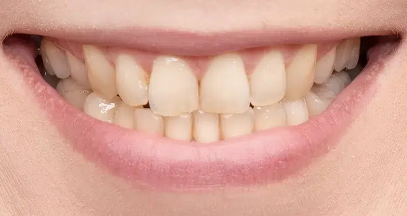Before professional teeth whitening North Hollywood