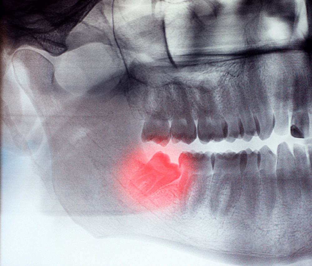X-ray panoramic of wisdom tooth