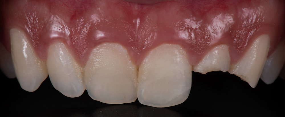 Before,And,After,Of,2,All,Ceramic,Dental,Crowns,To