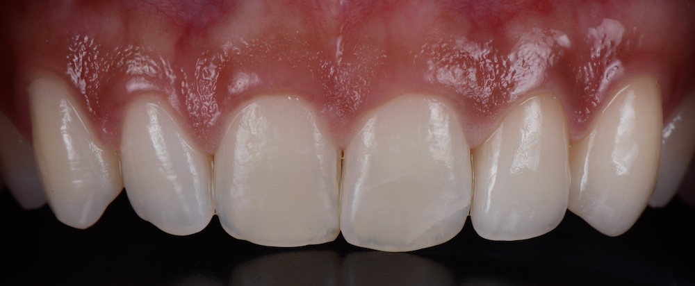 Before,And,After,Of,2,All,Ceramic,Dental,Crowns,To