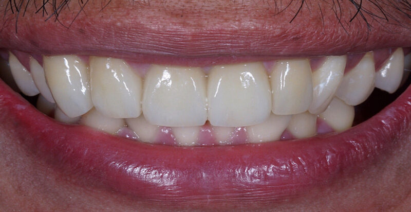 After implants and bonding North Hollywood