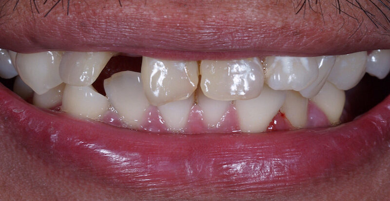 Before implants and bonding North Hollywood