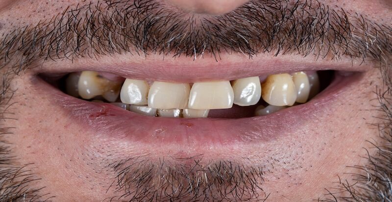 Before full smile redesign with implants and whitening