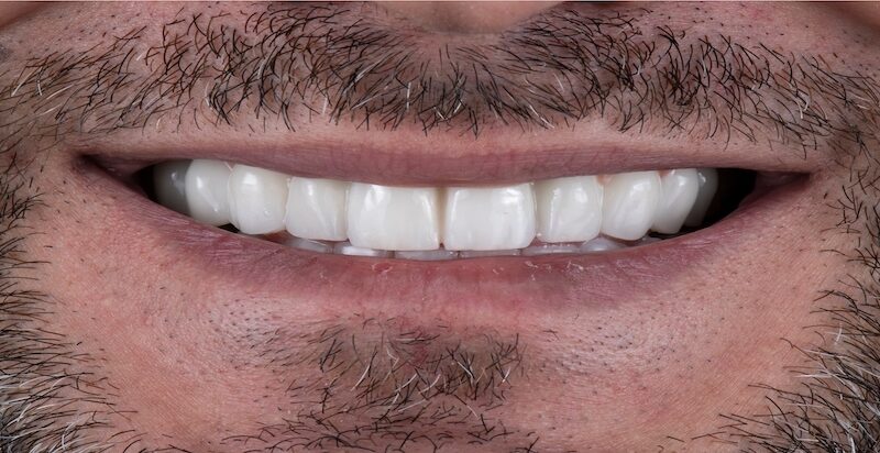 After full smile redesign with implants and whitening