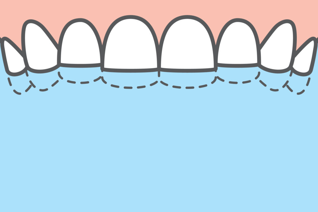 Blank,Banner,Upper,Attrition,(bruxism),Teeth,Illustration,Vector,On,Blue