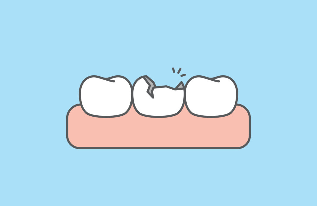 The,Broken,Tooth,White,Teeth,And,Gums,Illustration,Vector,Design