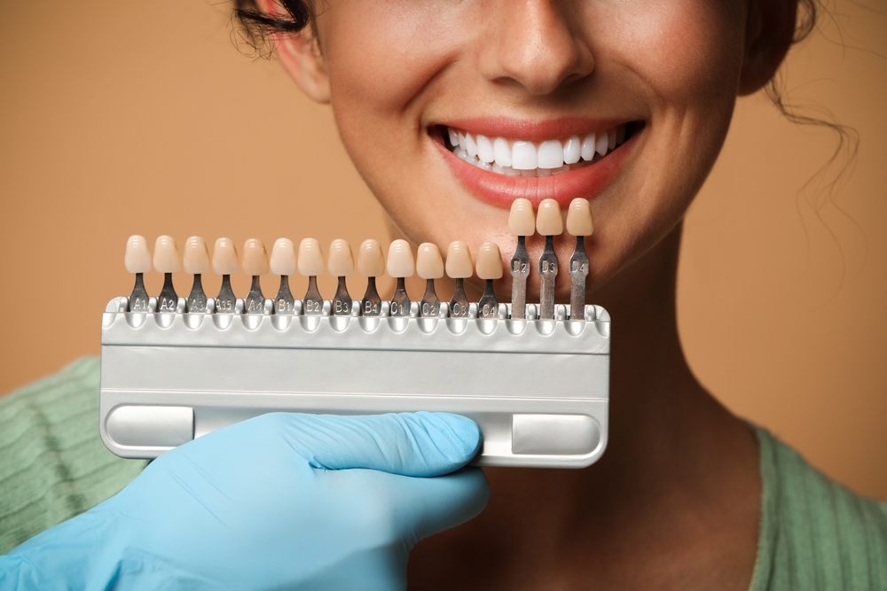 Dental veneers Los Angeles, CA. Dental veneers North Hollywood