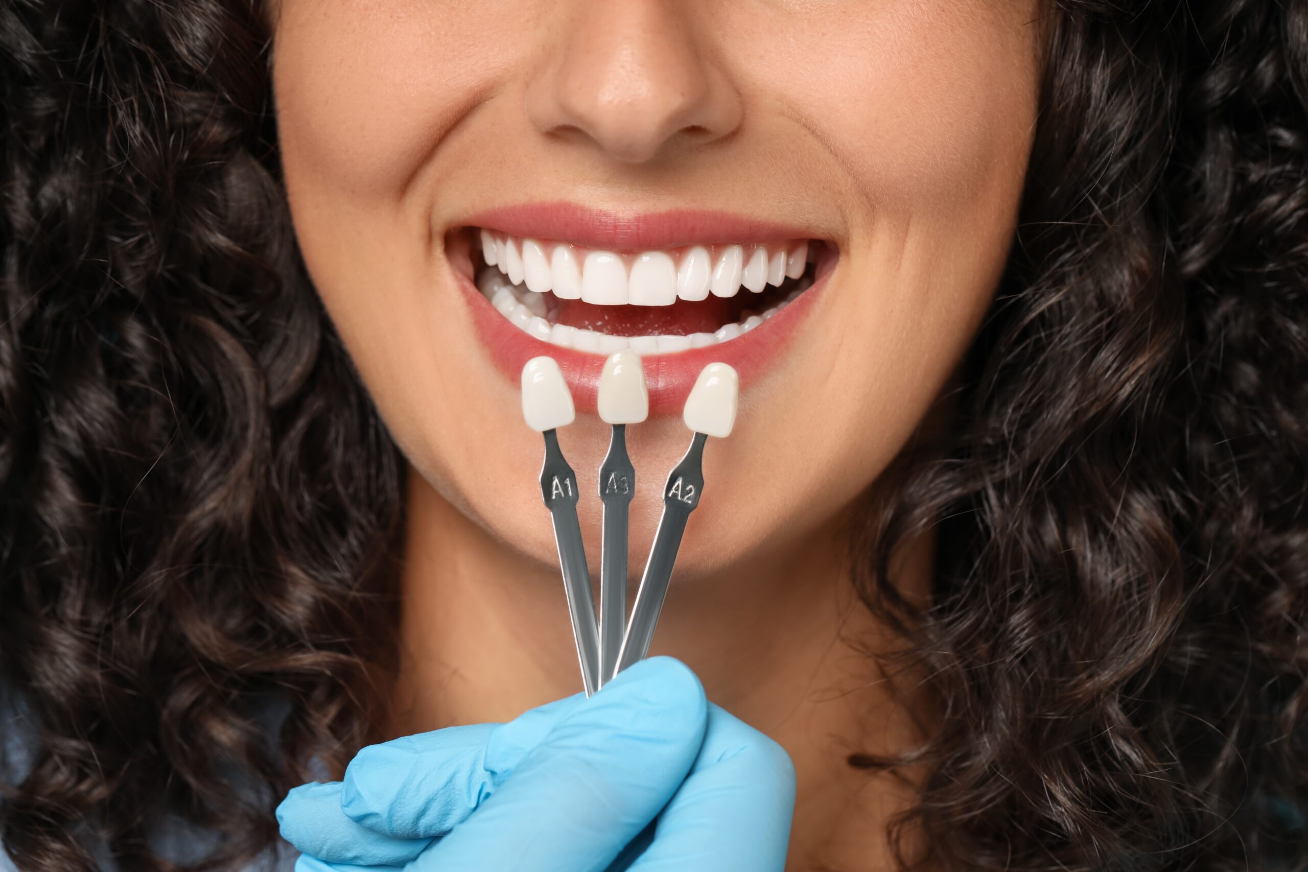 Smile transformation at Toluca Advanced Dentistry