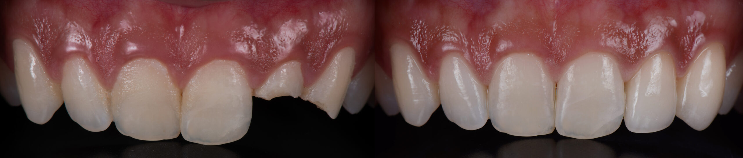 Before And After Of 2 All Ceramic Dental Crowns To Fix Broken Teeth