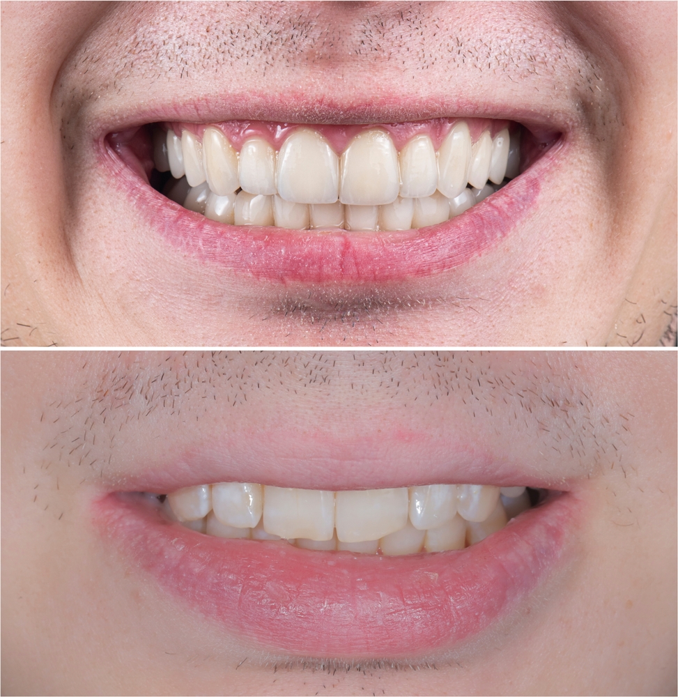 clear aligner before and after