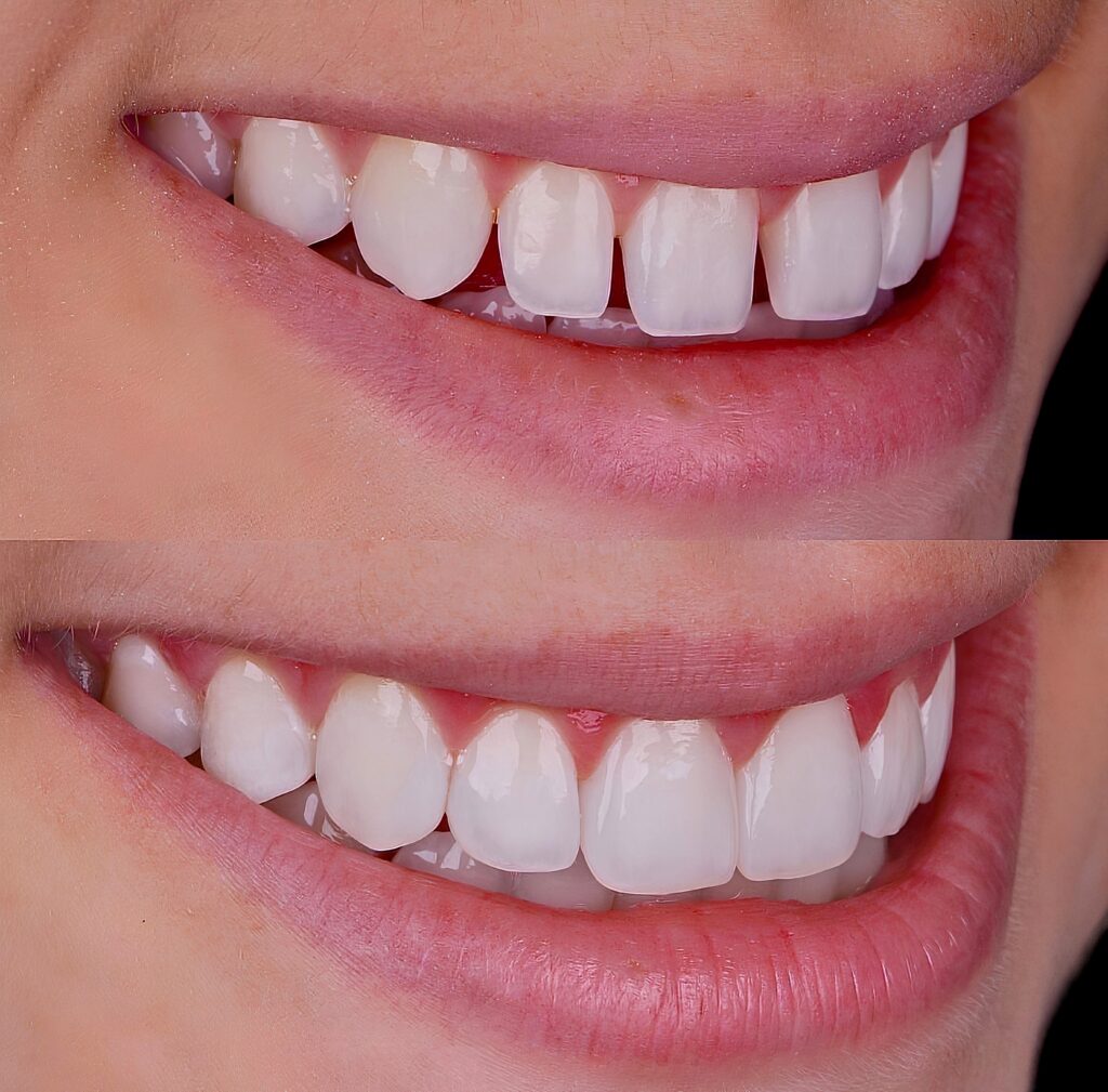 Dental,Smile,Design,Treatment,For,Crooked,And,Discolored,,Yellowed,Teeth,