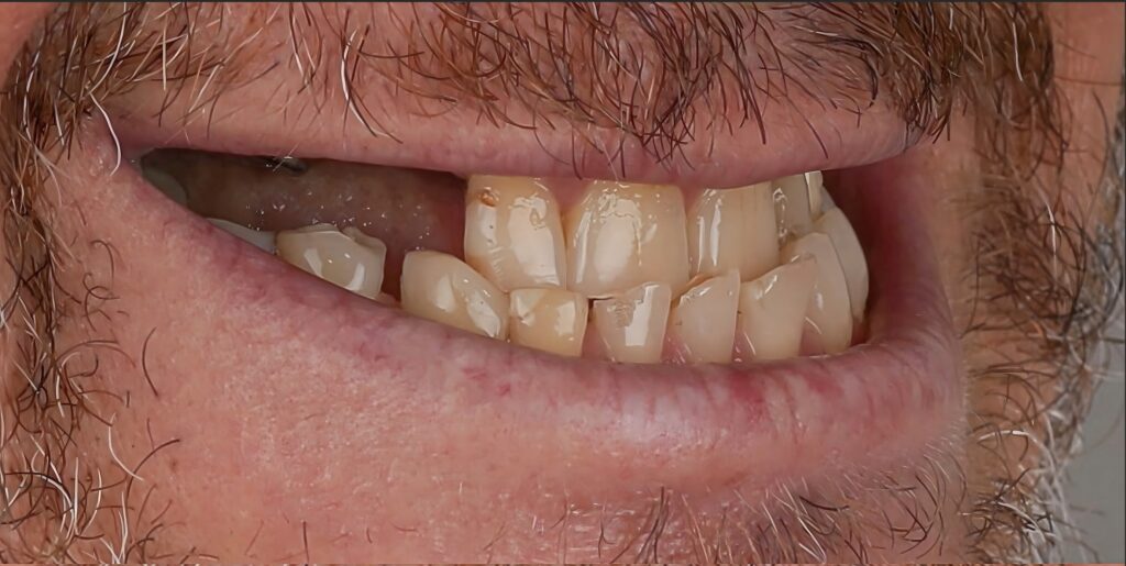 Before Full Smile Makeover in North Hollywood