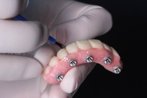 All-on-4 implant