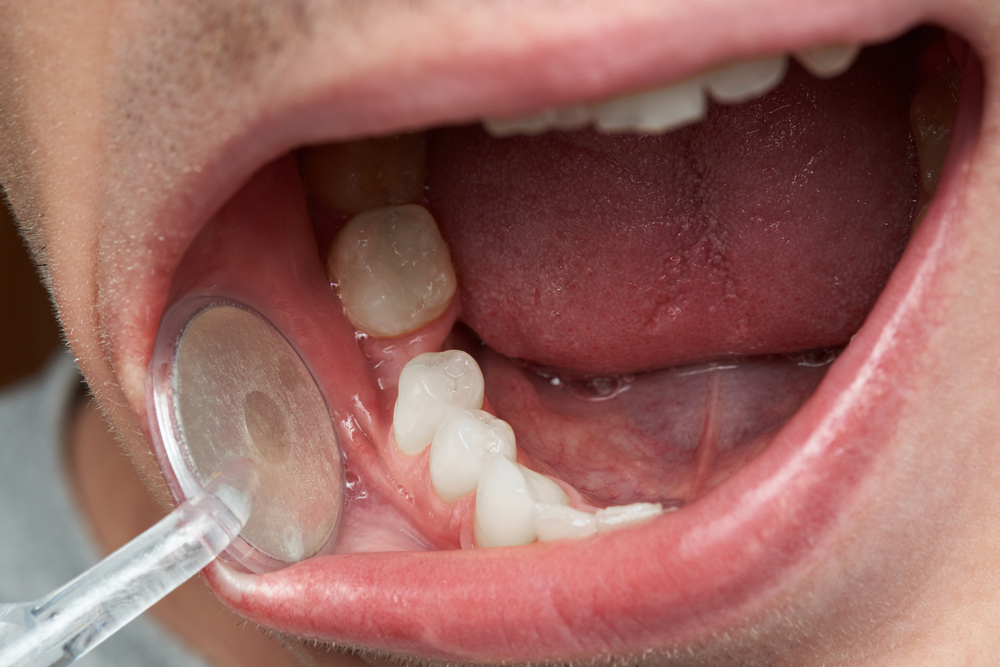 Dentist,Checking,Man,Teeth,Close up.,Macro,Of,Open,Mouth
