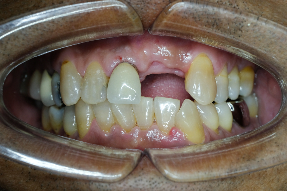 missing teeth solutions in north hollywood