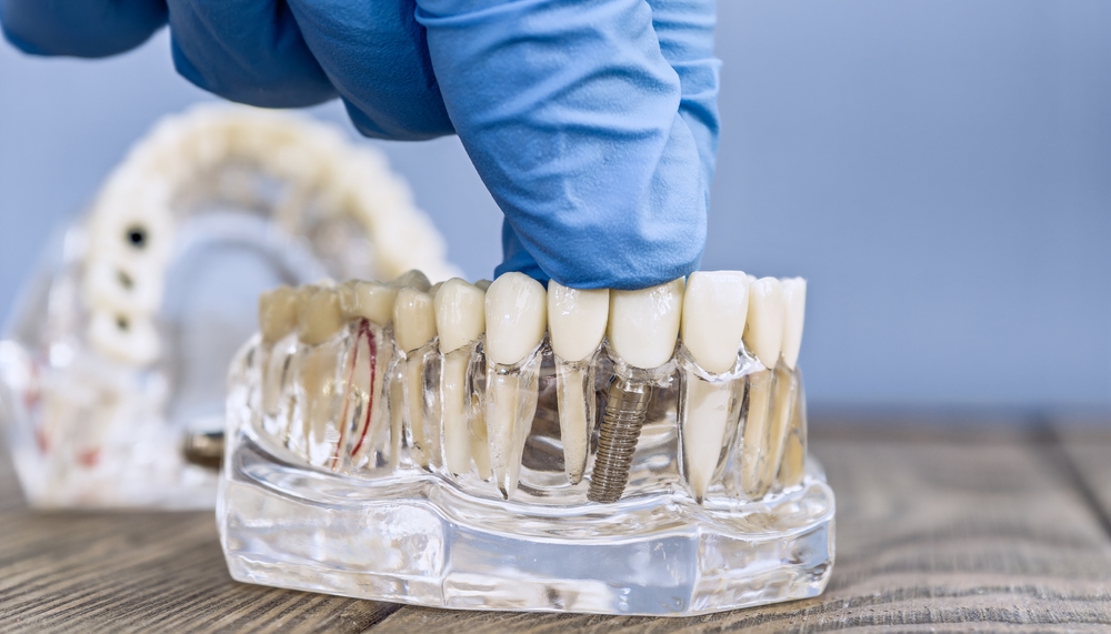 implant crown placement in toluca lake