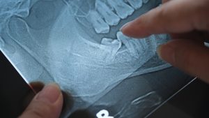 Wisdom tooth panoramic extraction in north hollywood
