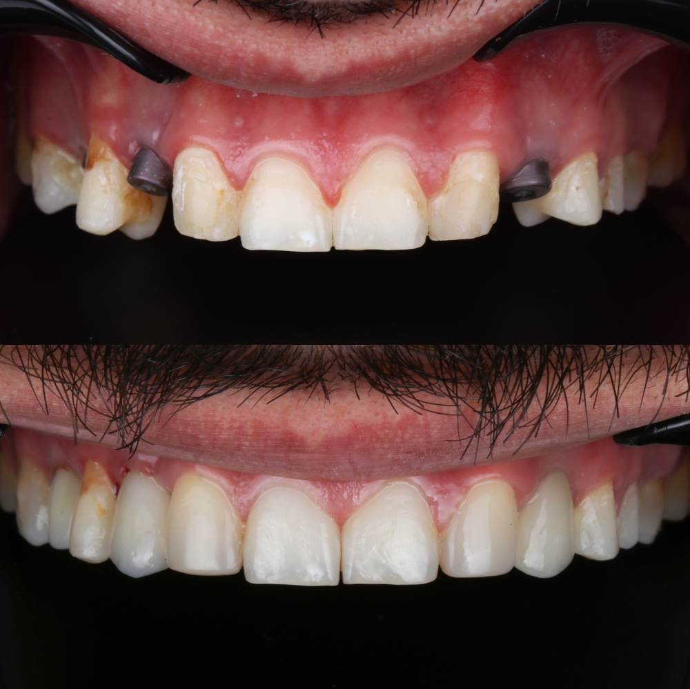 Dental implant before and after | top rated dental implant dentist in Los Angeles