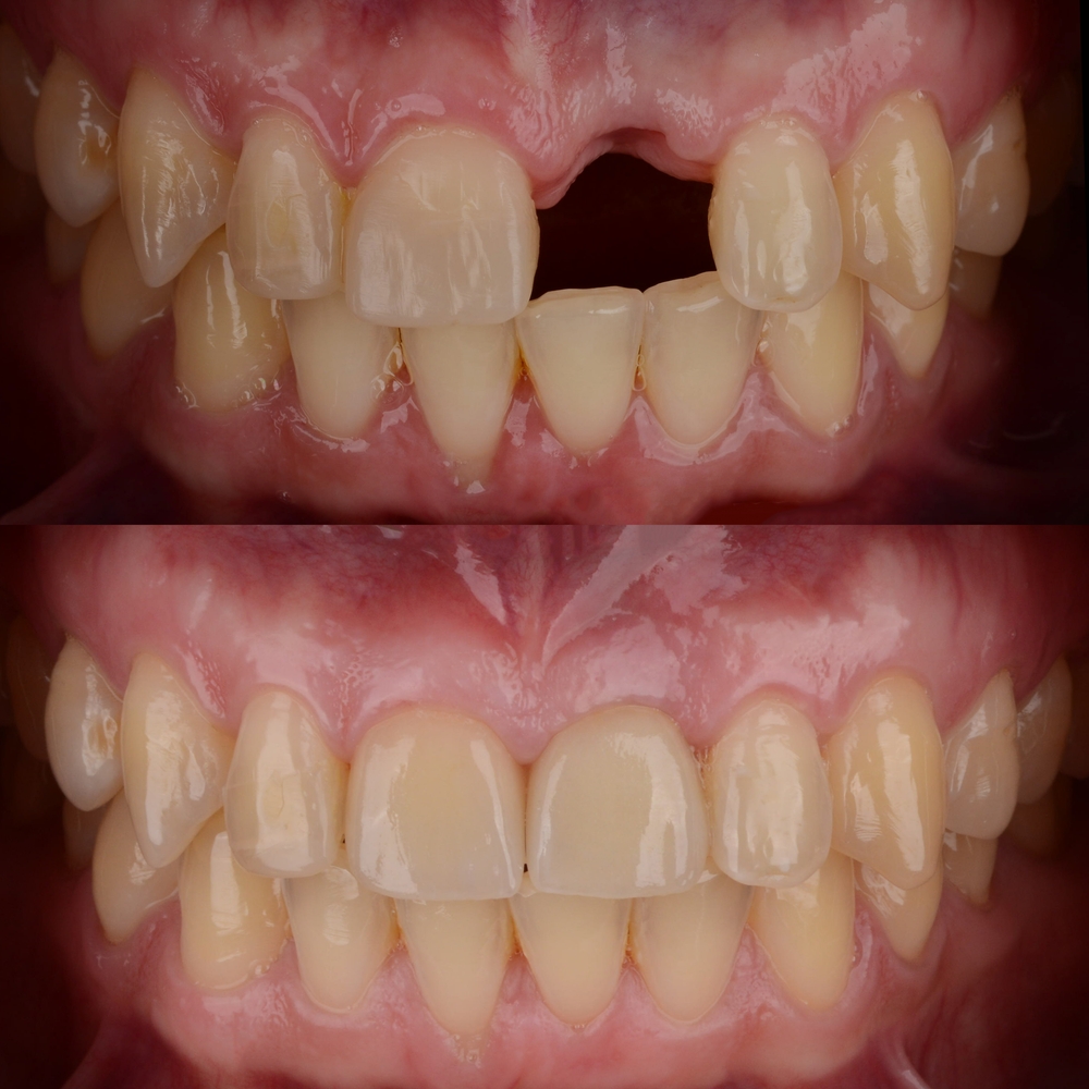 Dental implant before and after | top rated dental implant dentist in North Hollywood