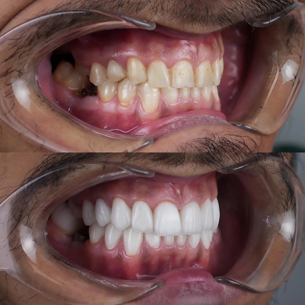 Dental implant before and after | top rated dental implant dentist in Toluca lake