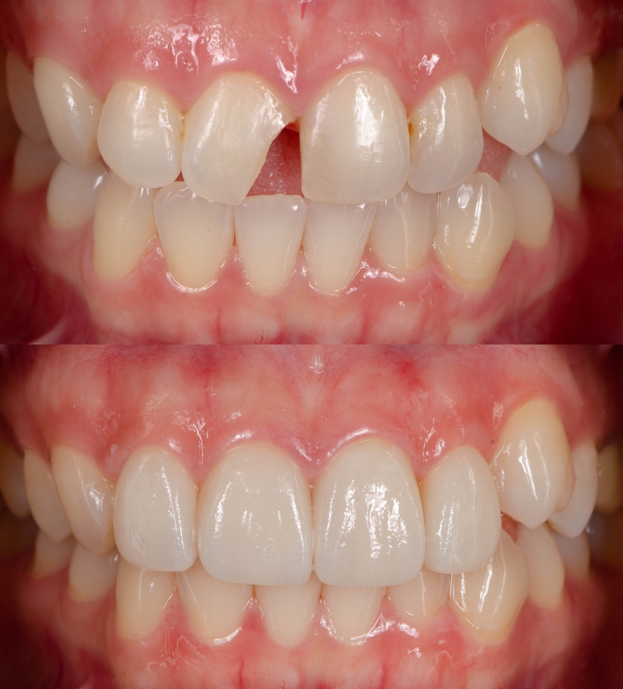 b4 and after chipped tooth fixed with dental bonding