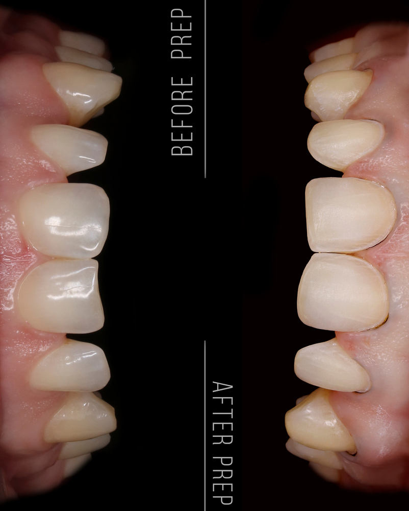 before and after prep for veneers